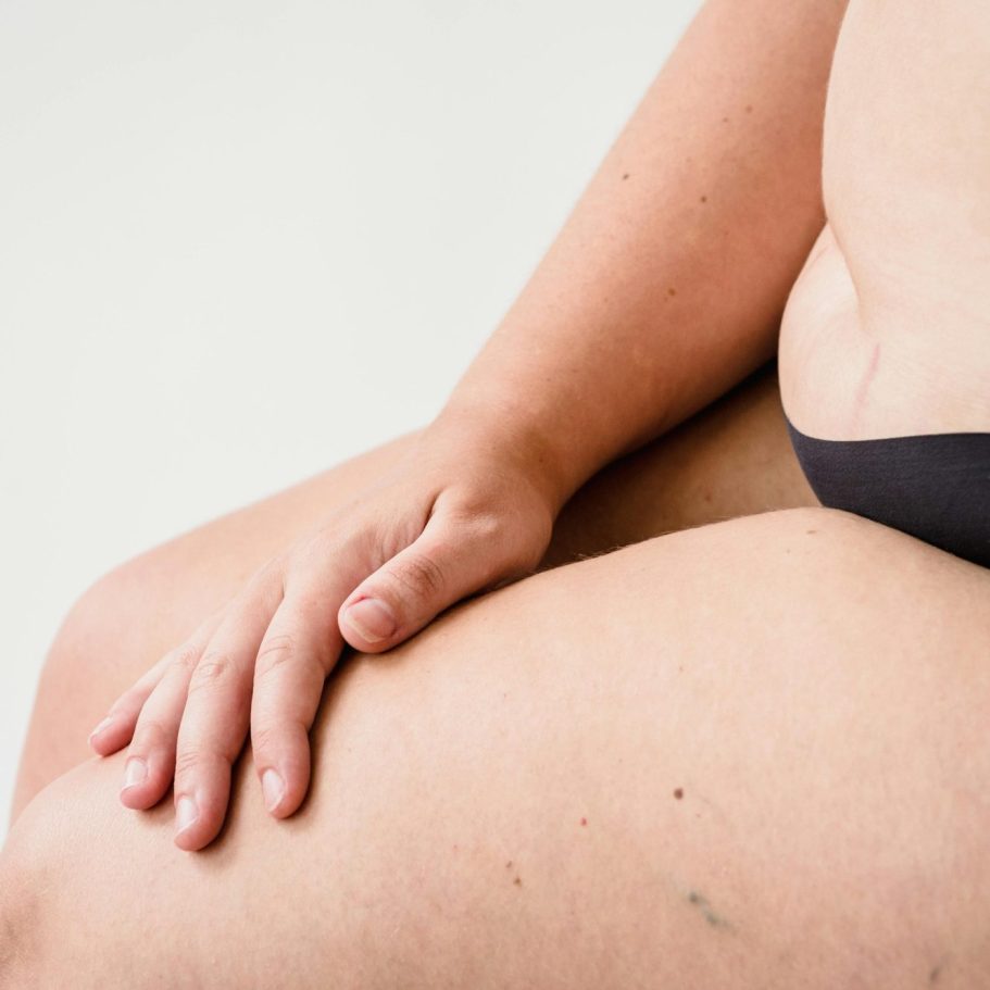 anti cellulitis, sinaasappelhuid,cellulitis behandeling, putjes in billen